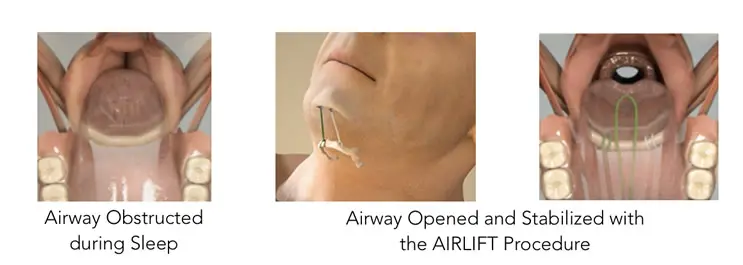 Airlift Procedures