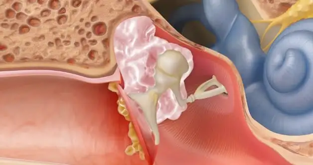 Cholesteatoma figure