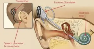 Diagram illustrating how a cochlear implant works. It shows a side view of an ear with labeled parts: transmitter, receiver/stimulator, electrode array, and a speech processor & microphone. An inset image highlights the external components.