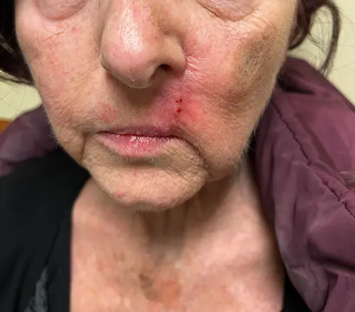 Lip Cancer After