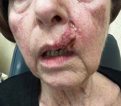 Lip Cancer Before