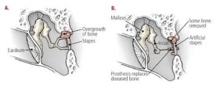 Otosclerosis