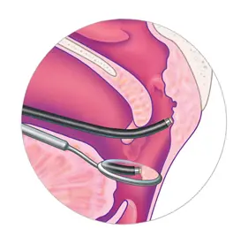 Coblation Adenoidectomy