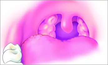 Coblation 1