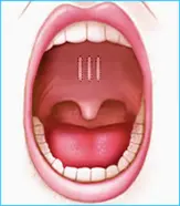 Illustration of an open human mouth showing the uvula and throat area. The tongue is visible at the bottom, and the interior of the mouth is pink. The lips are outlined and slightly parted.