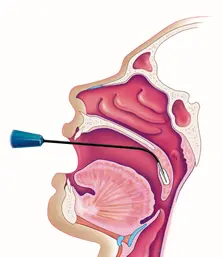 Palate Treatment