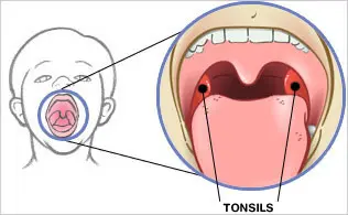 Tonsils