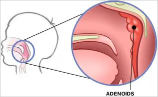 Adenoids