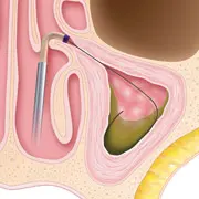 Sinuplasty surgery - step 1