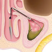 Sinuplasty surgery - step 2