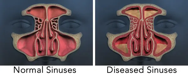 Sinus normal vs Diseased Sinuses