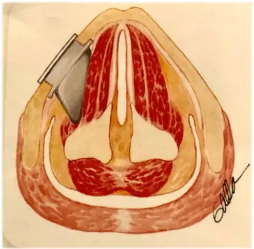Thyroplasty